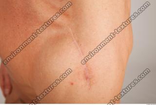 human skin scar 0002